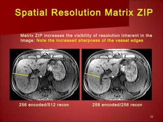 2222
Matrix ZIP increases the visibility of resolution inherent in the
Image: Note the increased sharpness of the vessel edges
256 encoded/512 recon 256 encoded/256 recon
Spatial Resolution Matrix ZIP
 