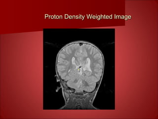 Proton Density Weighted ImageProton Density Weighted Image
 
