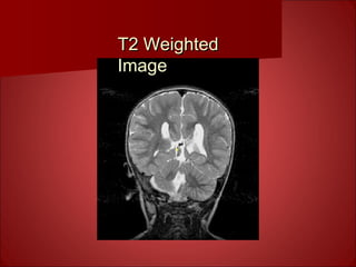 T2 WeightedT2 Weighted
ImageImage
 