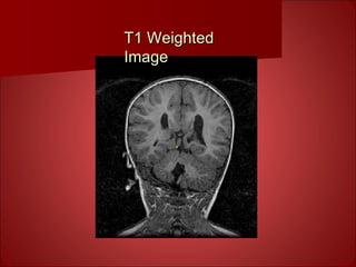T1 WeightedT1 Weighted
ImageImage
 