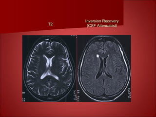 T2T2
Inversion RecoveryInversion Recovery
(CSF Attenuated)(CSF Attenuated)
 
