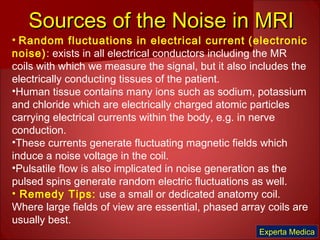 Sources of the Noise in MRISources of the Noise in MRI
• Random fluctuations in electrical current (electronic
noise): exists in all electrical conductors including the MR
coils with which we measure the signal, but it also includes the
electrically conducting tissues of the patient.
•Human tissue contains many ions such as sodium, potassium
and chloride which are electrically charged atomic particles
carrying electrical currents within the body, e.g. in nerve
conduction.
•These currents generate fluctuating magnetic fields which
induce a noise voltage in the coil.
•Pulsatile flow is also implicated in noise generation as the
pulsed spins generate random electric fluctuations as well.
• Remedy Tips: use a small or dedicated anatomy coil.
Where large fields of view are essential, phased array coils are
usually best.
Experta Medica
 