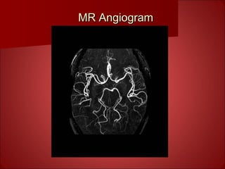 MR AngiogramMR Angiogram
 