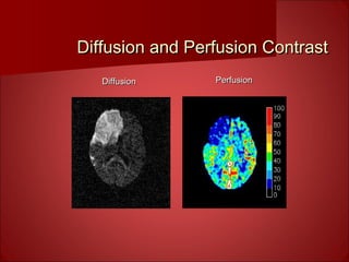 PerfusionPerfusionDiffusionDiffusion
Diffusion and Perfusion ContrastDiffusion and Perfusion Contrast
 