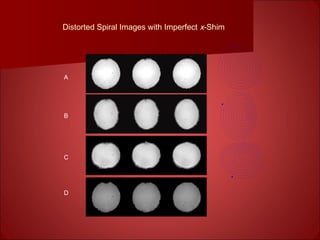Distorted Spiral Images with Imperfect x-Shim
A
B
C
D
 
