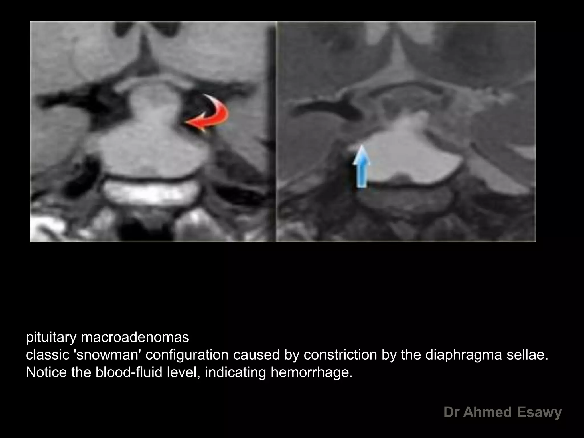 mri-imaging-hypothalamus-dr-ahmed-esawy-pdf