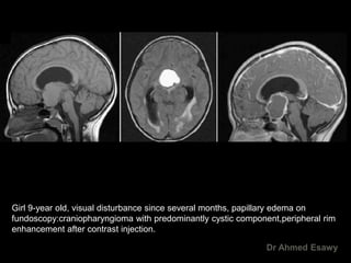 MRI imaging hypothalamus Dr Ahmed Esawy | PDF