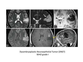 Dner Cancer MRI imaging of brain tumors. A practical approach. | PPTX