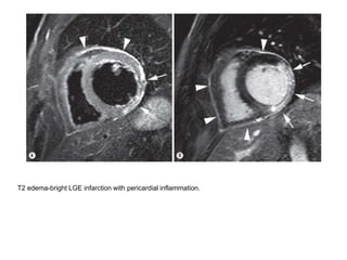 Lge Infarction CARDIAC MRI IN ISCHEMIC HEART DISEASES | PPTX