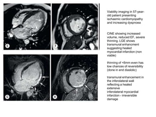 Lge Infarction CARDIAC MRI IN ISCHEMIC HEART DISEASES | PPTX