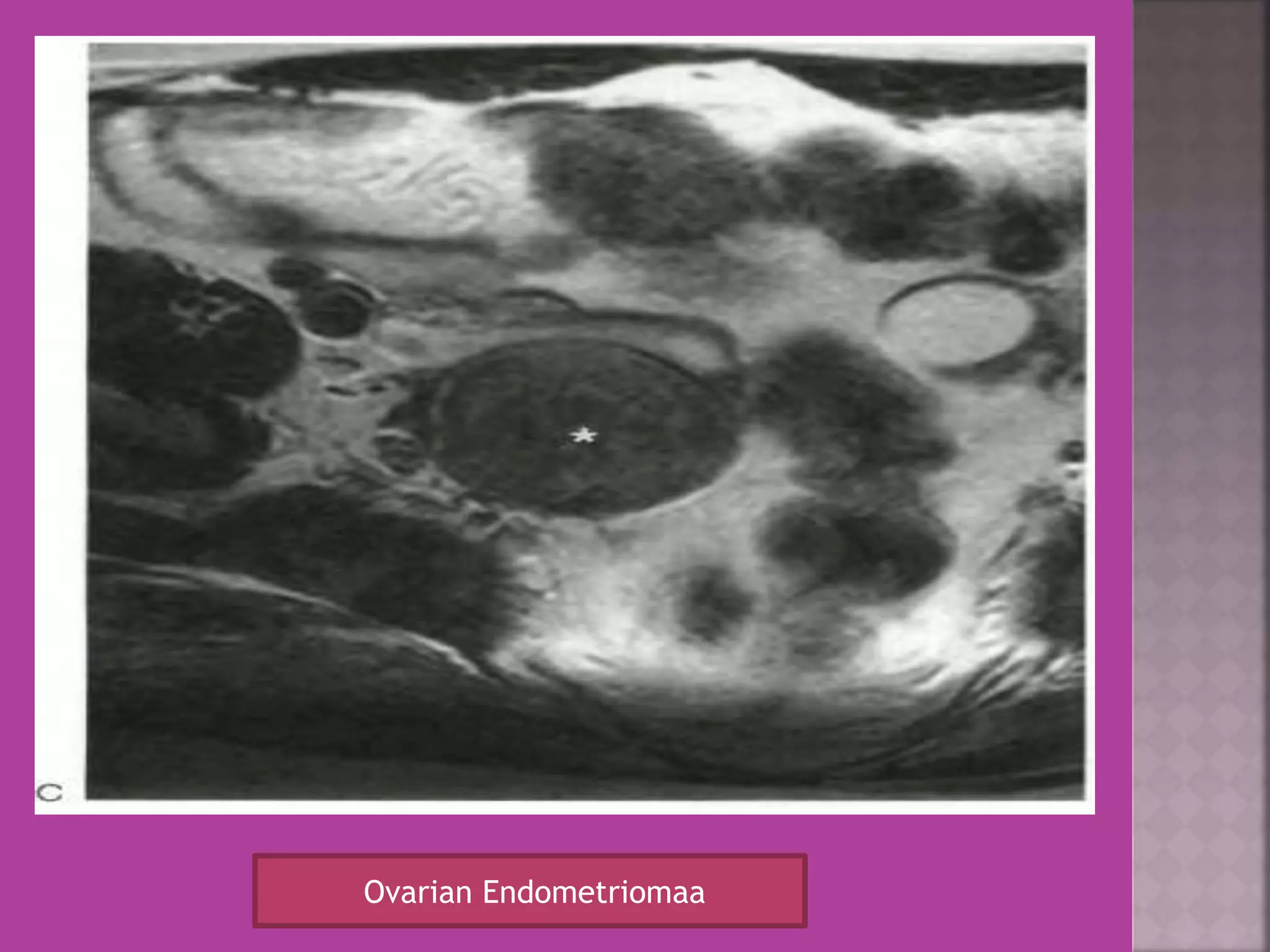 Ovarian Endometriomaa 
 