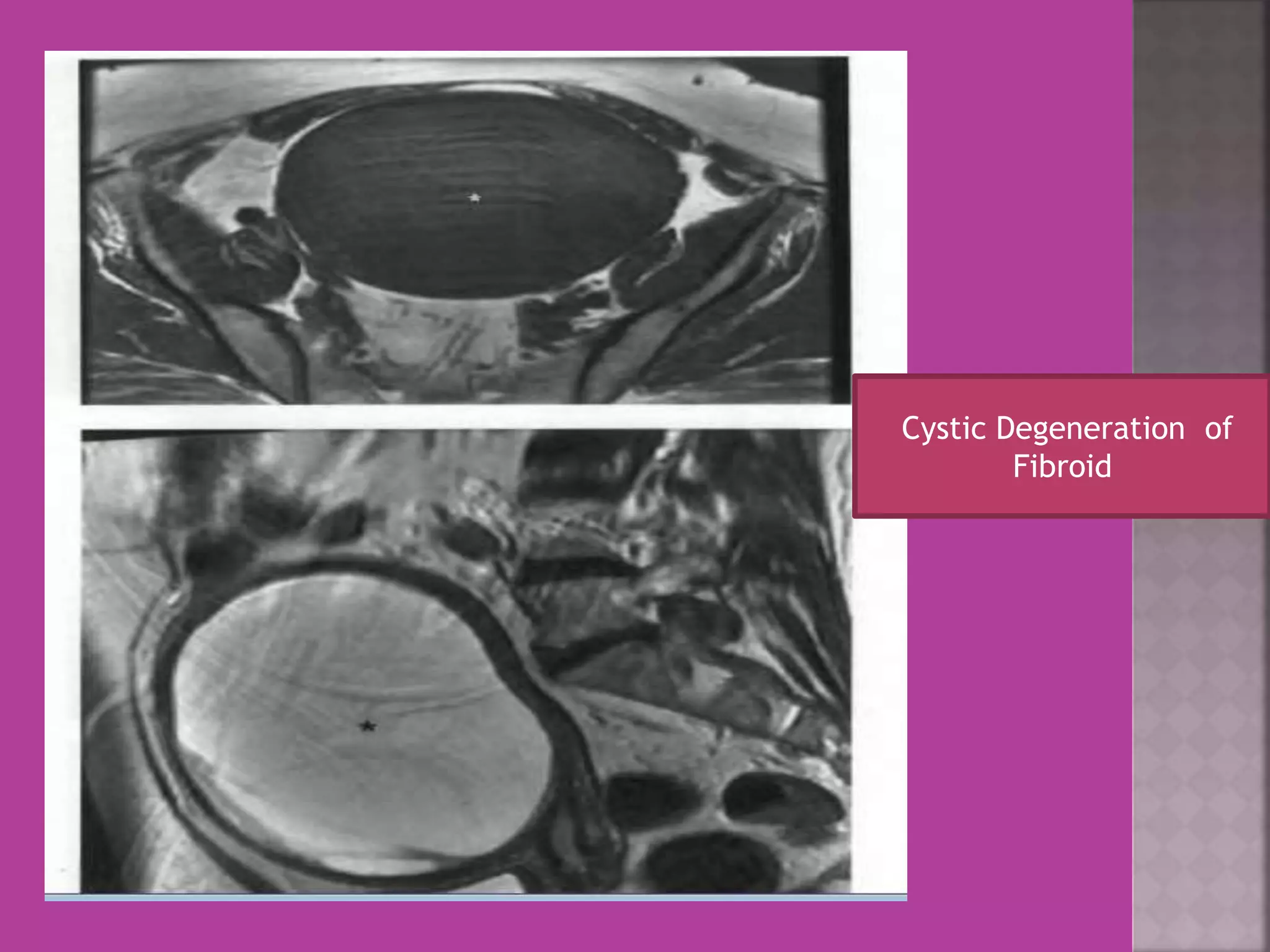 Cystic Degeneration of 
Fibroid 
 