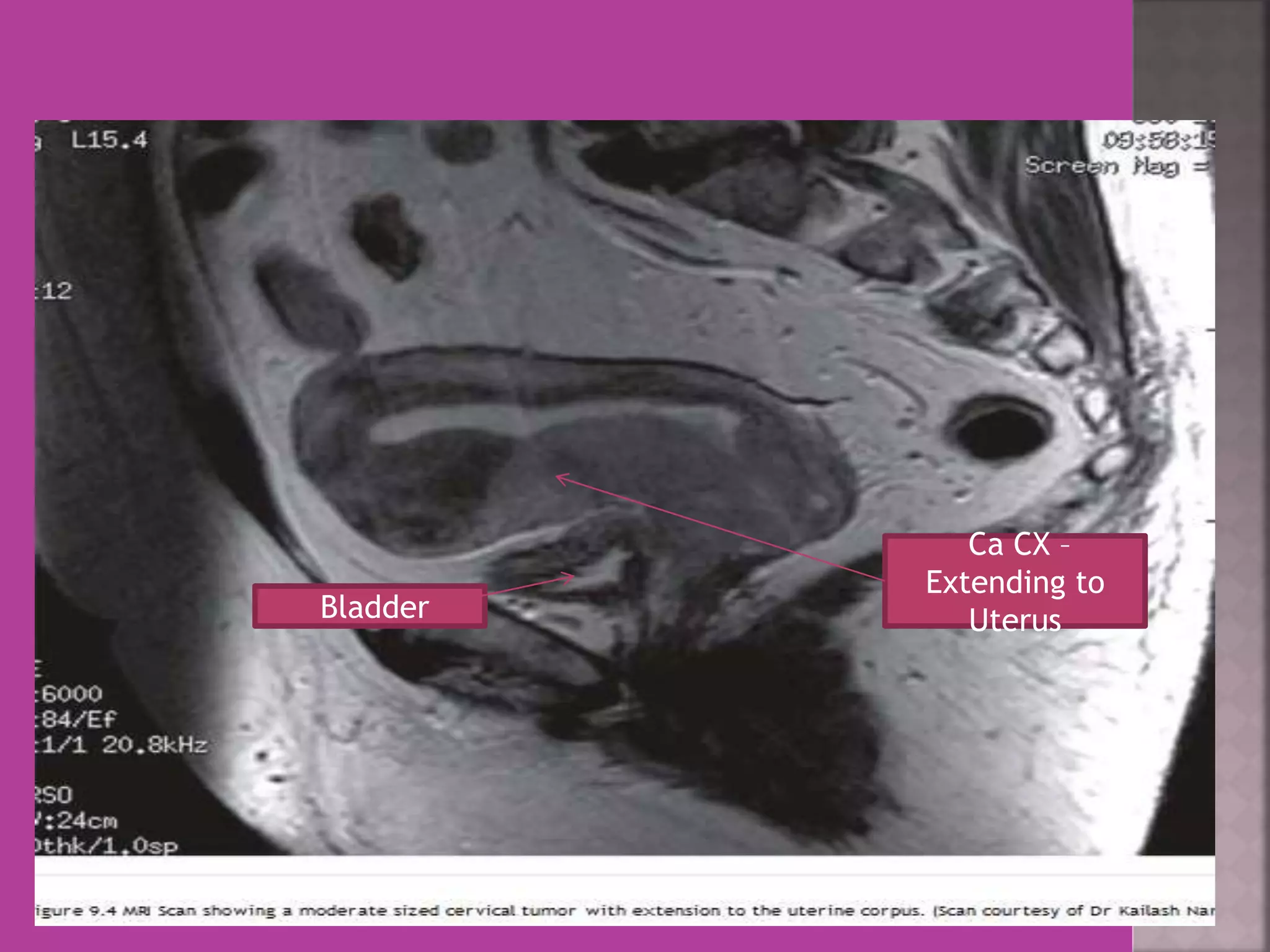 Ca CX – 
Extending to 
Bladder Uterus 
 