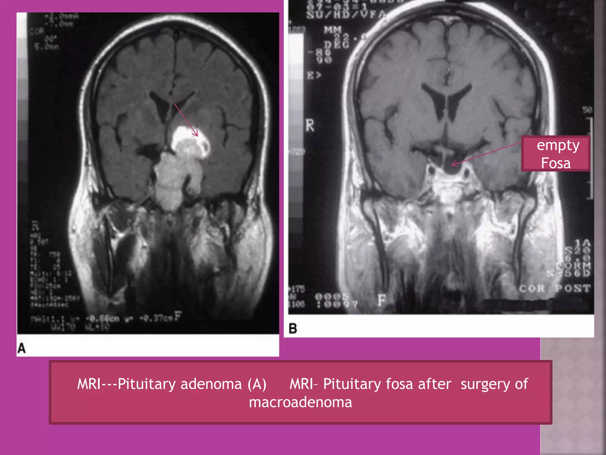 MRI---Pituitary adenoma (A) MRI– Pituitary fosa after surgery of 
macroadenoma 
empty 
Fosa 
 