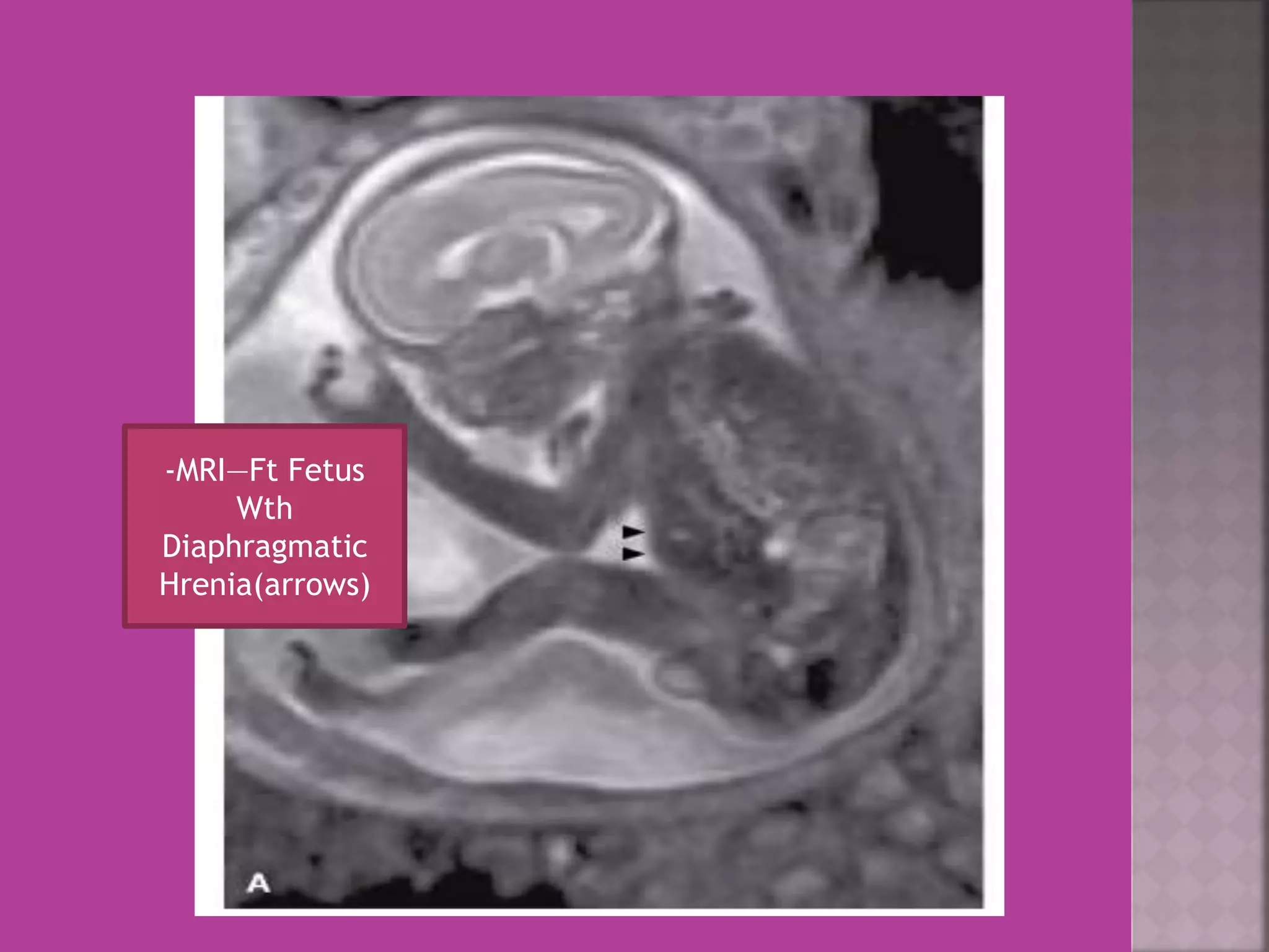 -MRI—Ft Fetus 
Wth 
Diaphragmatic 
Hrenia(arrows) 
 