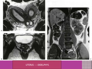 UTERUS ----DIDELPHYS 
 
