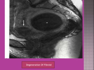 Degeneration Of Fibroid 
 