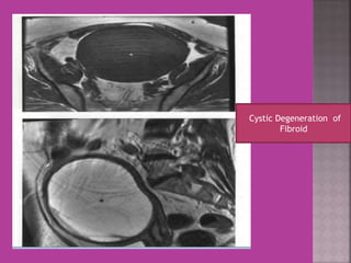 Cystic Degeneration of 
Fibroid 
 
