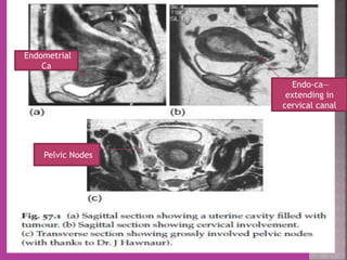 Endometrial 
Ca 
Endo-ca— 
extending in 
cervical canal 
Pelvic Nodes 
 