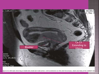 Ca CX – 
Extending to 
Bladder Uterus 
 