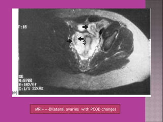 MRI-----Bilateral ovaries with PCOD changes 
 