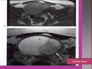 Ovarian Tumor 
 
