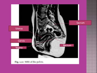 Uterus 
Cervix 
Vagina 
Rectum 
Sacrum 
 