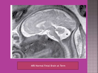 MRI Normal Fetal Brain at Term 
 