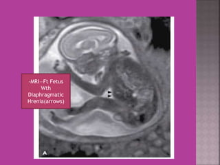 -MRI—Ft Fetus 
Wth 
Diaphragmatic 
Hrenia(arrows) 
 