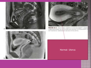 Normal- Uterus 
 