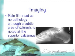 Mri In Stress Fractures