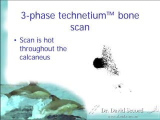 Mri In Stress Fractures