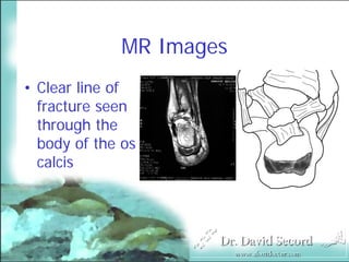 Mri In Stress Fractures