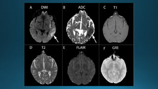 MRI IN  STROKE RADIOLOGY PRESENTATION...