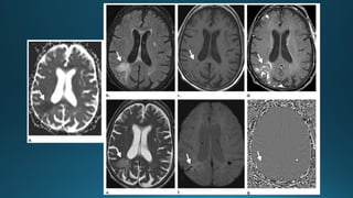 MRI IN  STROKE RADIOLOGY PRESENTATION...