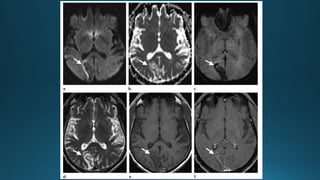MRI IN  STROKE RADIOLOGY PRESENTATION...