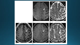 MRI IN  STROKE RADIOLOGY PRESENTATION...