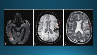 MRI IN  STROKE RADIOLOGY PRESENTATION...