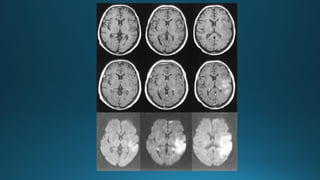 MRI IN  STROKE RADIOLOGY PRESENTATION...