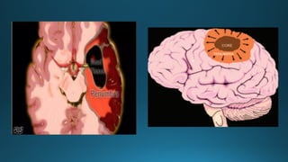 MRI IN  STROKE RADIOLOGY PRESENTATION...