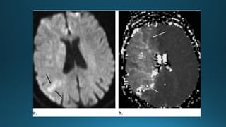 MRI IN  STROKE RADIOLOGY PRESENTATION...