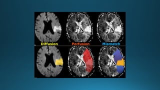 MRI IN  STROKE RADIOLOGY PRESENTATION...