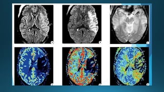 MRI IN  STROKE RADIOLOGY PRESENTATION...
