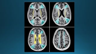 MRI IN  STROKE RADIOLOGY PRESENTATION...