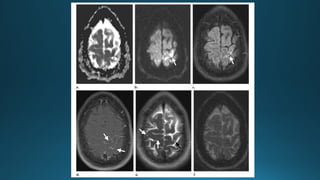 MRI IN  STROKE RADIOLOGY PRESENTATION...