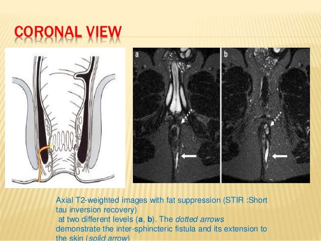 Mri in surgery