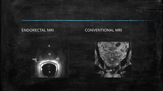ENDORECTAL MRI CONVENTIONAL MRI
 