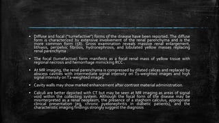 ▪ Diffuse and focal (“tumefactive”) forms of the disease have been reported. The diffuse
form is characterized by extensive involvement of the renal parenchyma and is the
more common form (58). Gross examination reveals massive renal enlargement,
lithiasis, peripelvic fibrosis, hydronephrosis, and lobulated yellow masses replacing
renal parenchyma .
▪ The focal (tumefactive) form manifests as a focal renal mass of yellow tissue with
regional necrosis and hemorrhage mimicking RCC .
▪ At MR imaging, the renal parenchyma is compressed by dilated calices and replaced by
abscess cavities with intermediate signal intensity on T1-weighted images and high
signal intensity onT2-weighted images.
▪ Cavity walls may show marked enhancement after contrast material administration.
▪ Calculi are better depicted with CT but may be seen at MR imaging as areas of signal
void within the collecting system. Although the focal form of the disease may be
misinterpreted as a renal neoplasm, the presence of a staghorn calculus, appropriate
clinical presentation (eg, chronic pyelonephritis in diabetic patients), and the
characteristic imaging findings strongly suggest the diagnosis
 