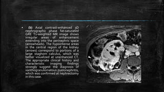 ▪ (b) Axial contrast-enhanced 3D
nephrographic phase fat-saturated
GRE T1-weighted MR image shows
irregular areas of enhancement
extending into the perinephric space
(arrowheads). The hypointense areas
in the central region of the kidney
(arrows) correspond to portions of a
large staghorn calculus, which was
better visualized at unenhanced CT.
The appropriate clinical history and
characteristic imaging findings
strongly suggest the diagnosis of
xanthogranulomatous pyelonephritis,
which was confirmed at nephrectomy
in this case.
 