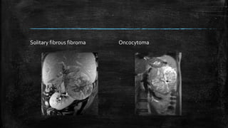 Solitary fibrous fibroma Oncocytoma
 